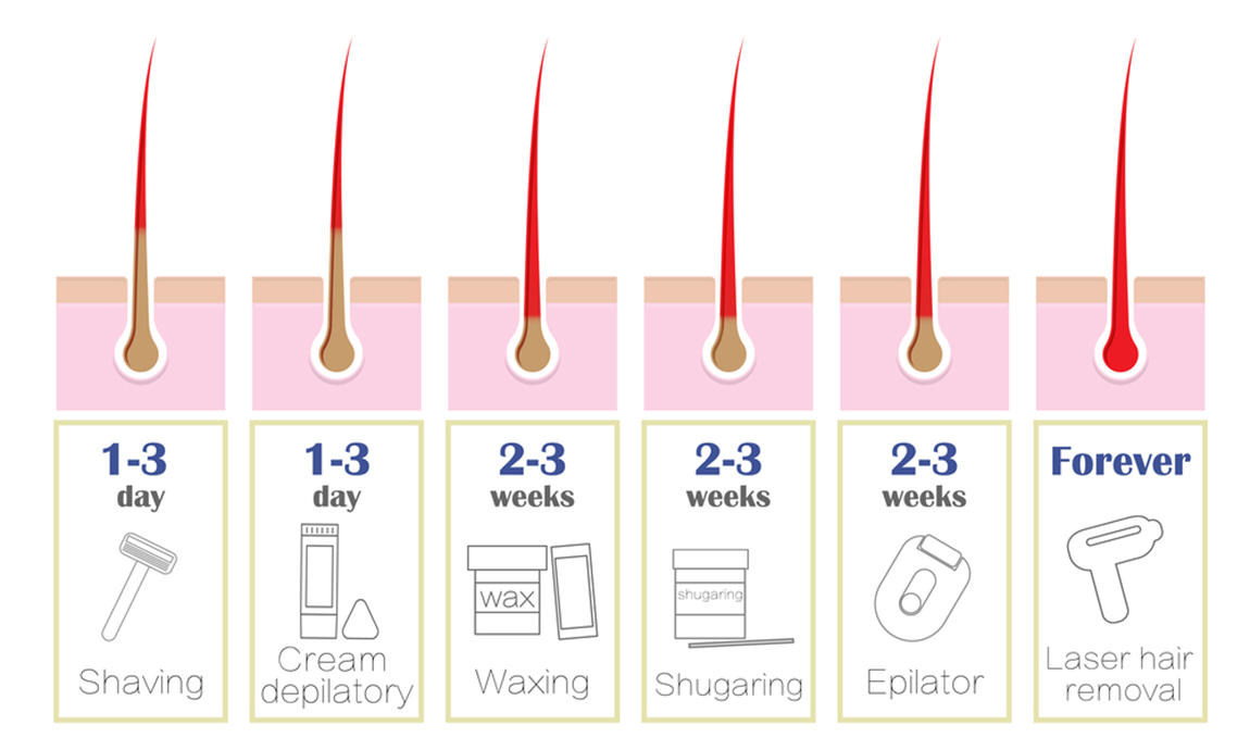 نکات قبل از لیزر موهای زائد
