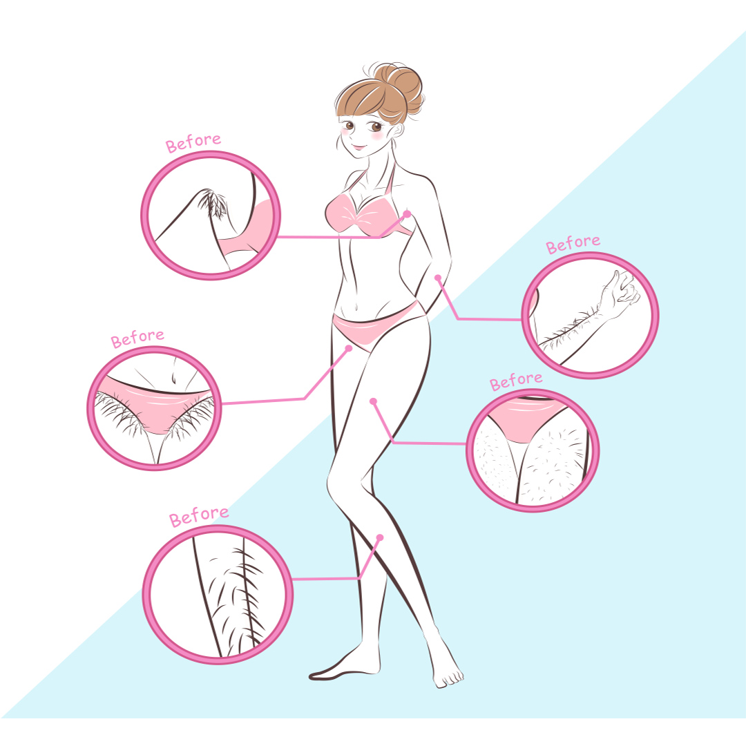 جلسه اول لیزر موهای زائد