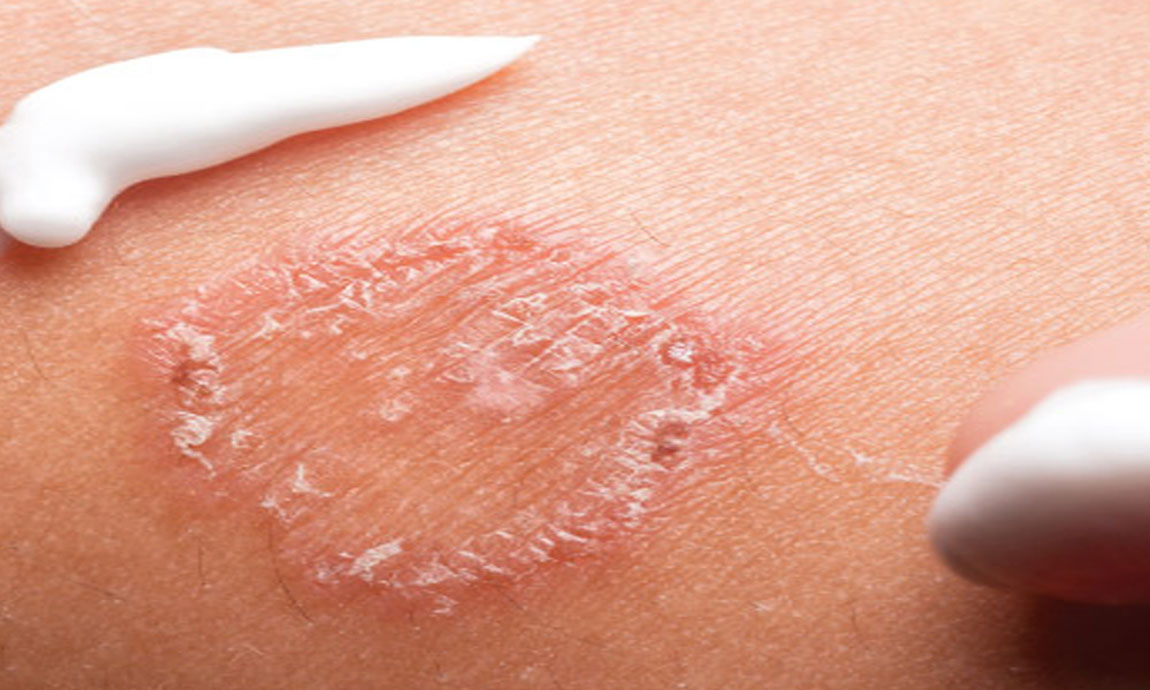 جلوگیری از بیماری های پوستی