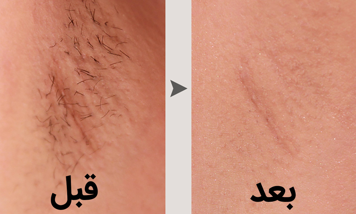 نکات قبل از لیزر موهای زائد