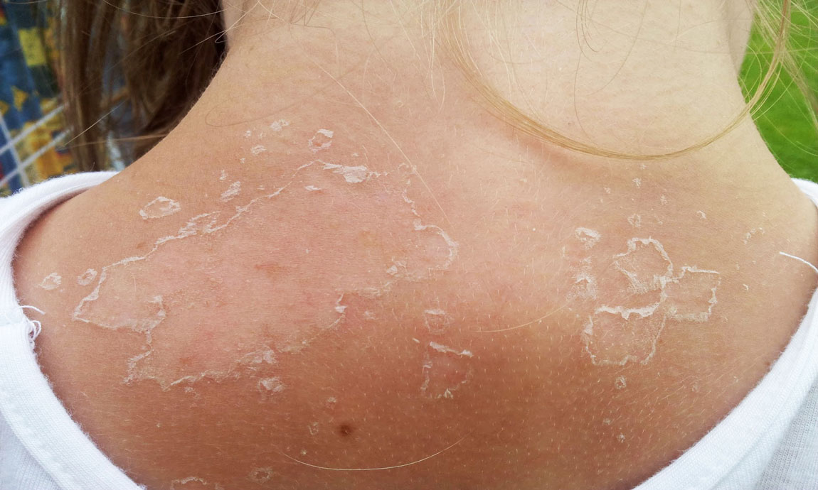 آفتاب گرفتن