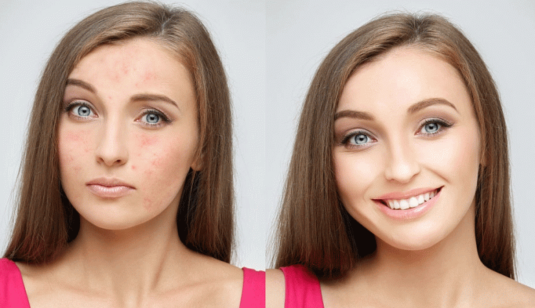 درمان جای جوش