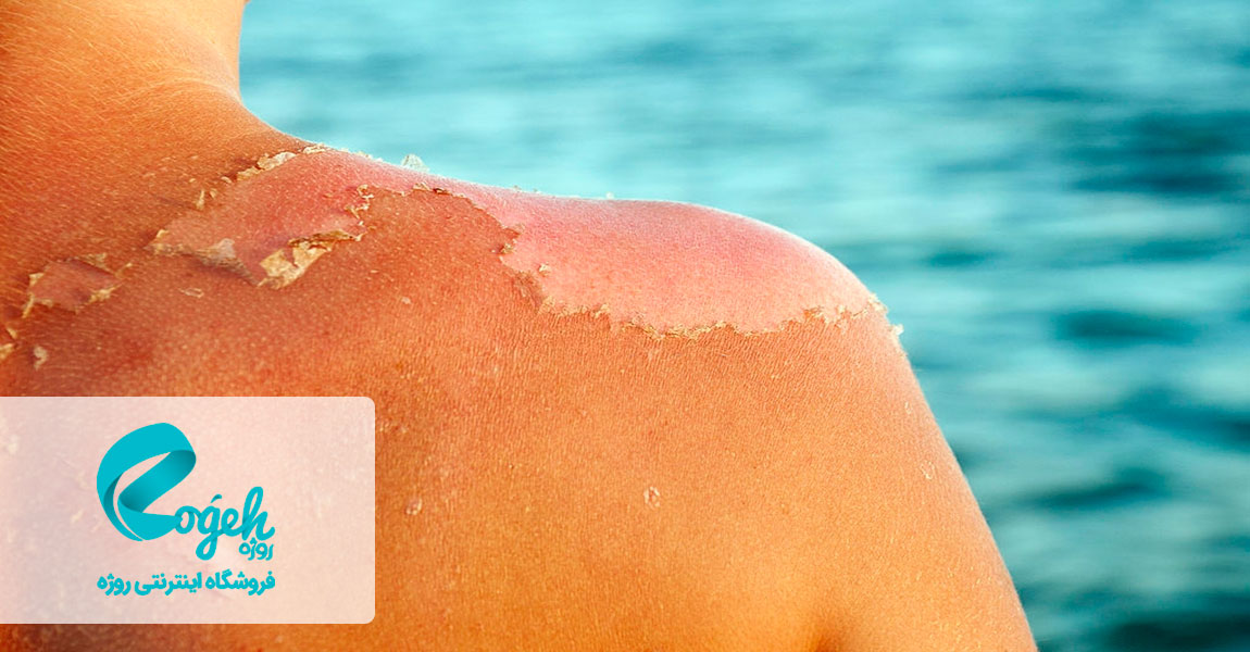 فواید آلوئه ورا برای پوست