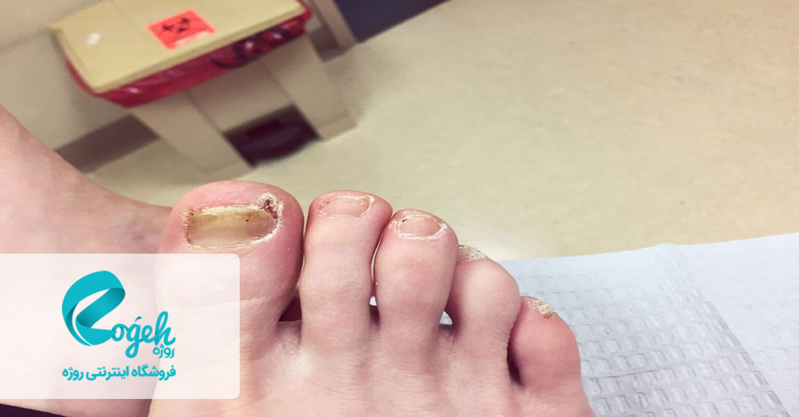 مشکلات دیابت برای پوست و مو