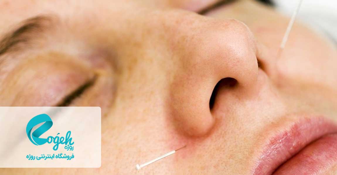 فواید طب سوزنی