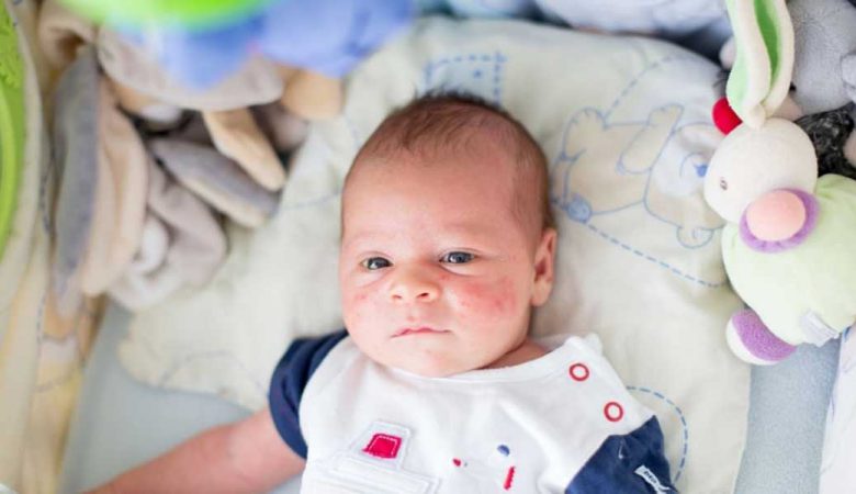 قارچ پوستی در کودکان