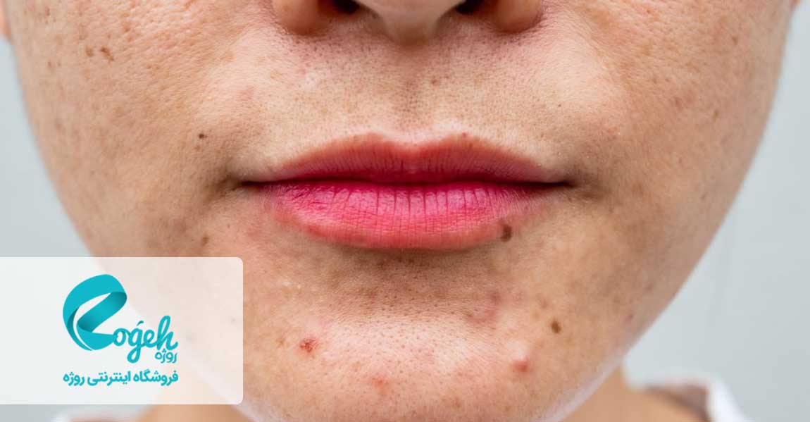 عوارض راکوتان