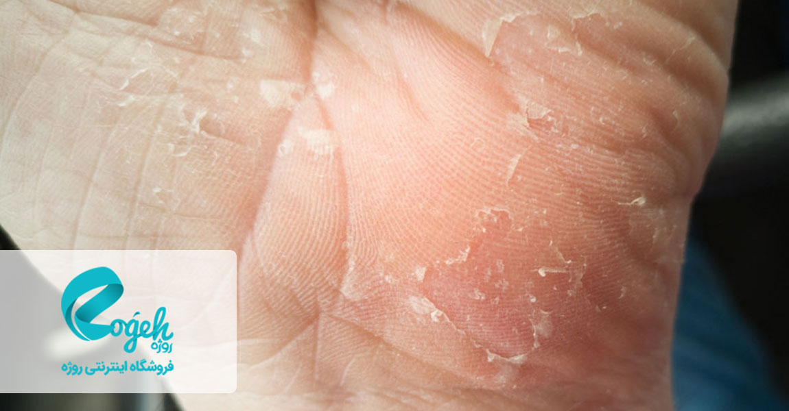 بیماری پسوریازیس