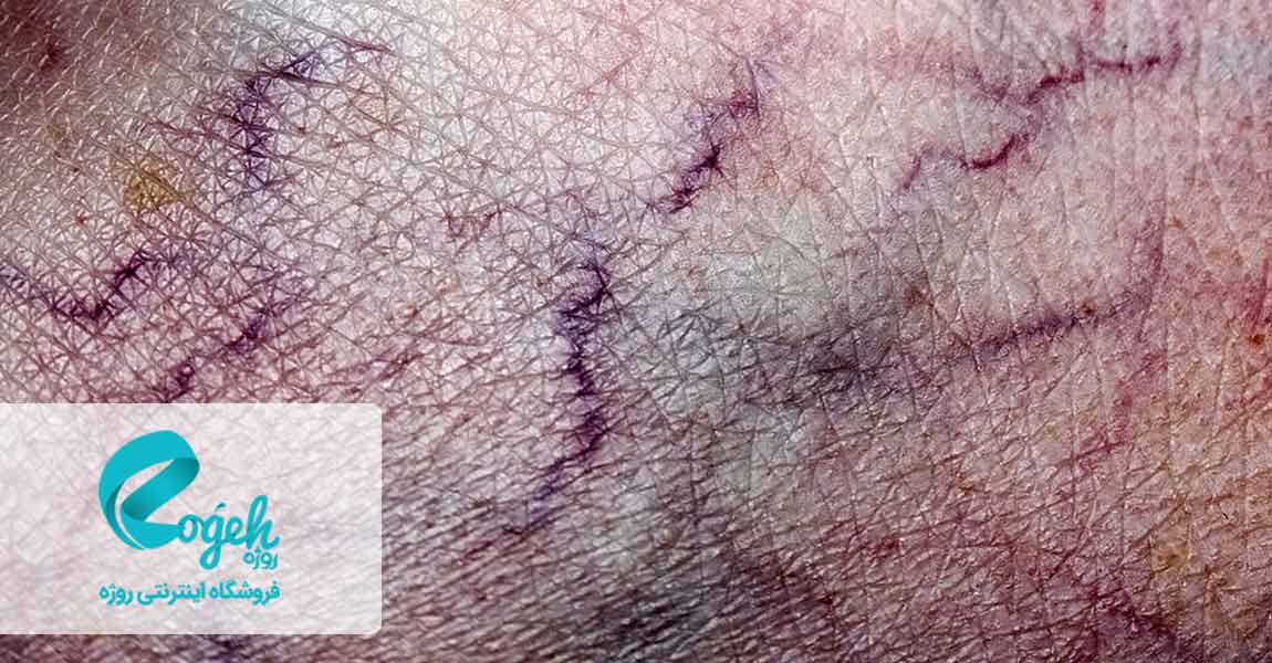 درمان واریس بارداری