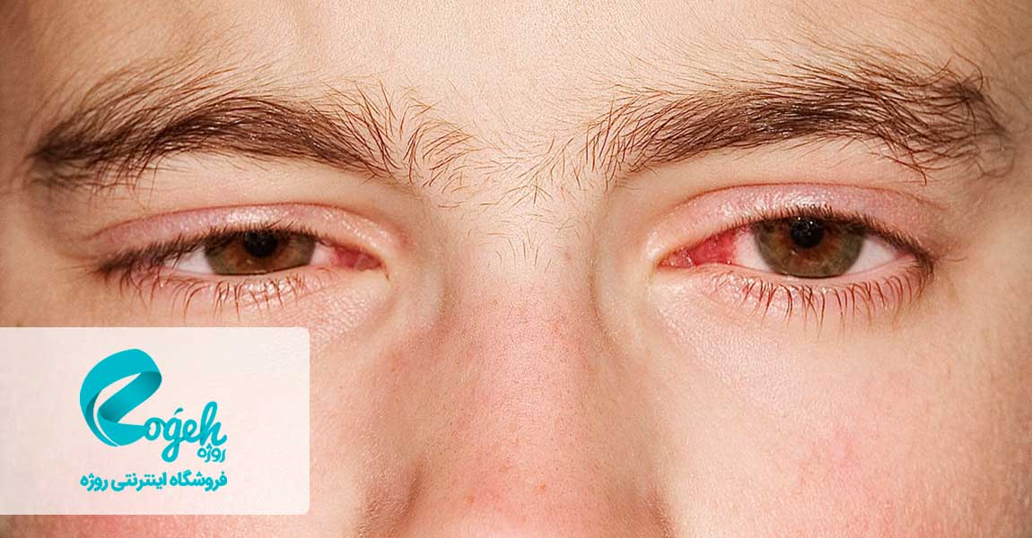 درمان انحراف چشم