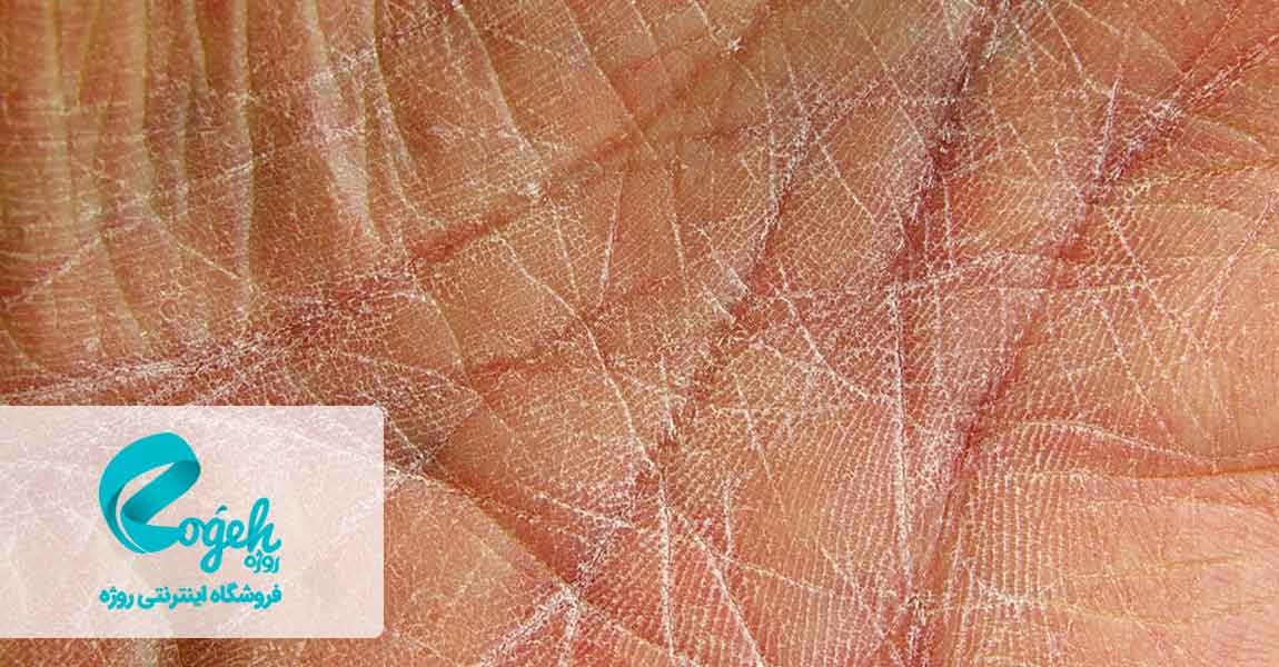 علائم گواتر