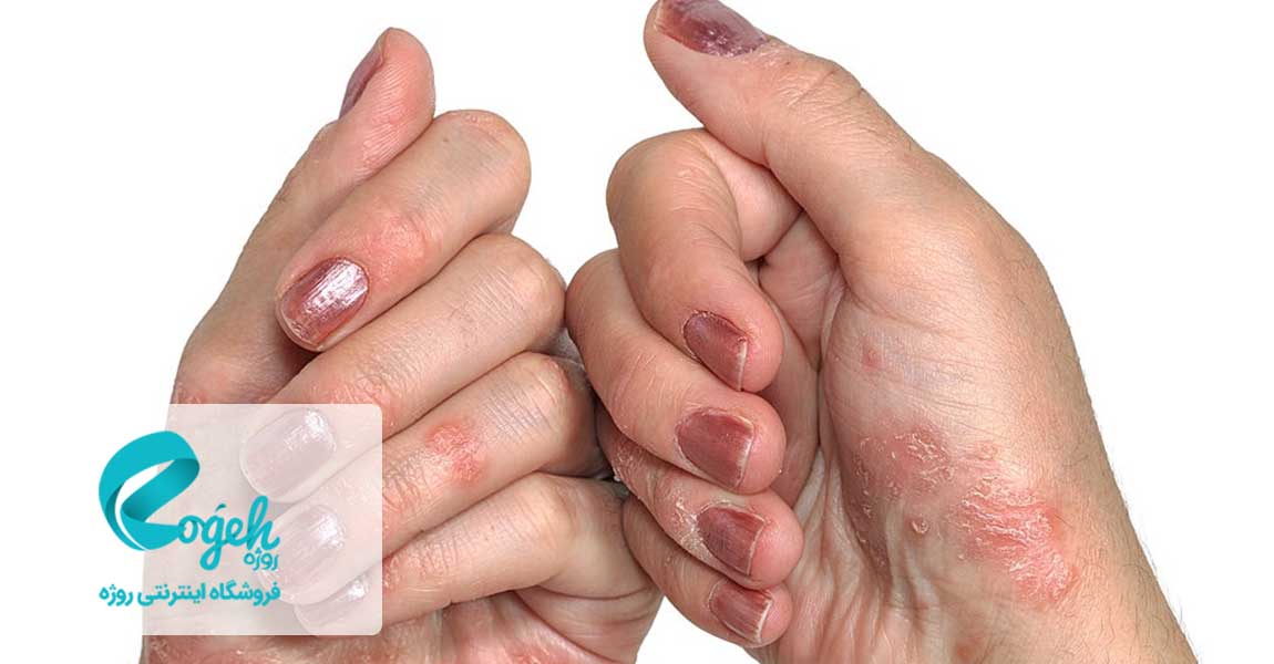 بیماری پسوریازیس