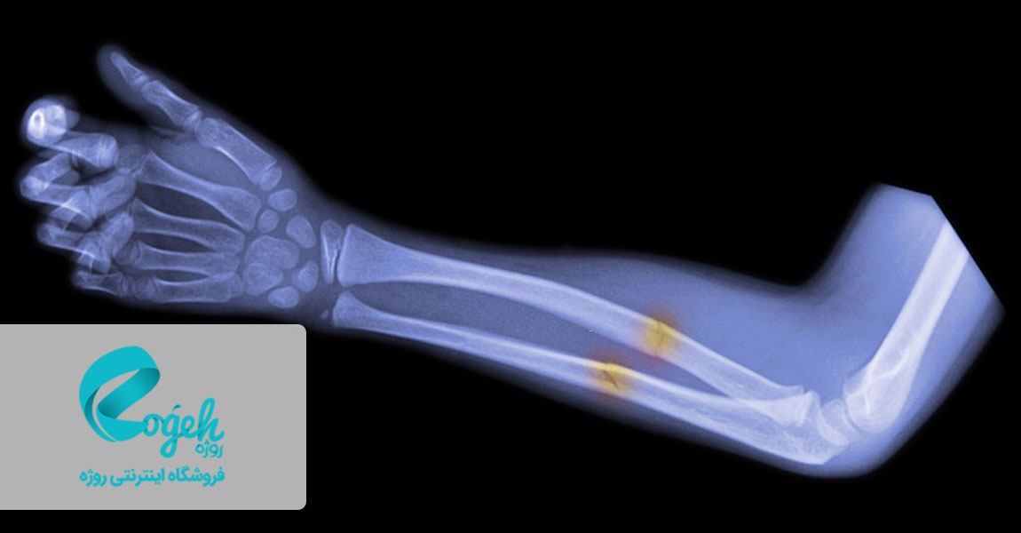 مصرف مواد غذایی برای جوش خوردن استخوان