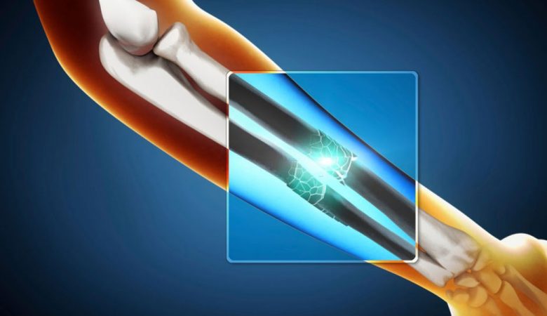 مصرف مواد غذایی برای جوش خوردن استخوان