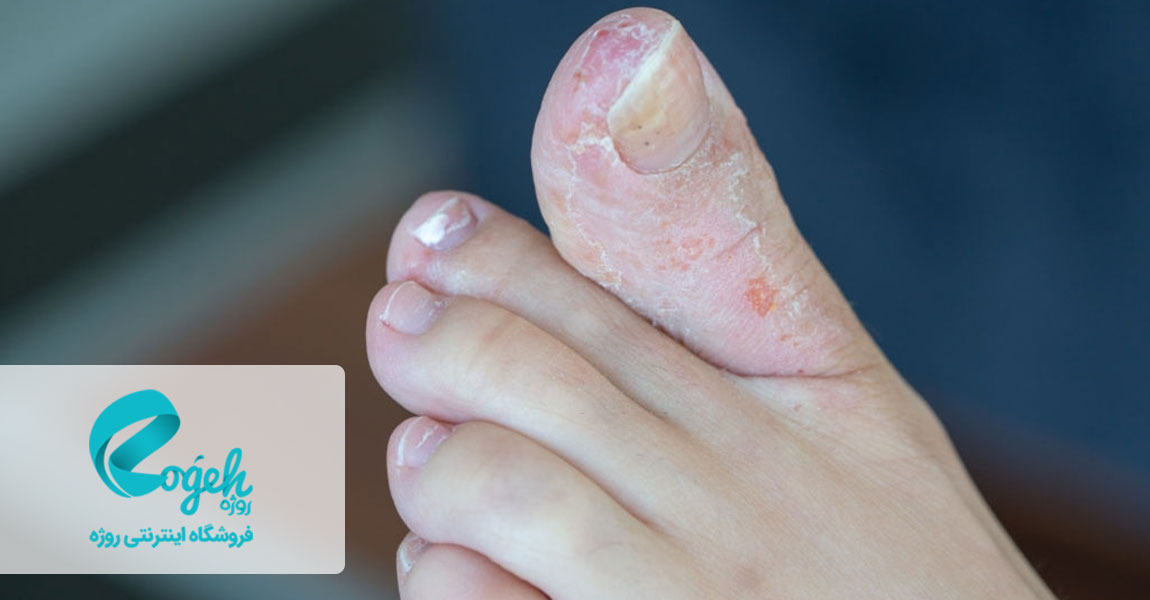 قارچ پای ورزشکار