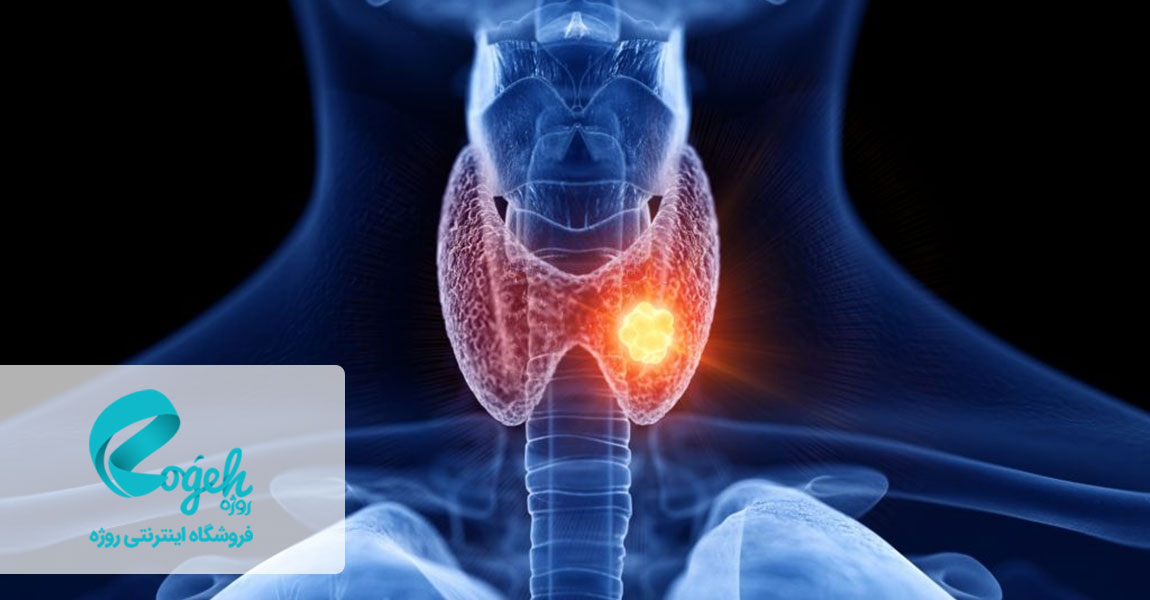سرطان تیروئید