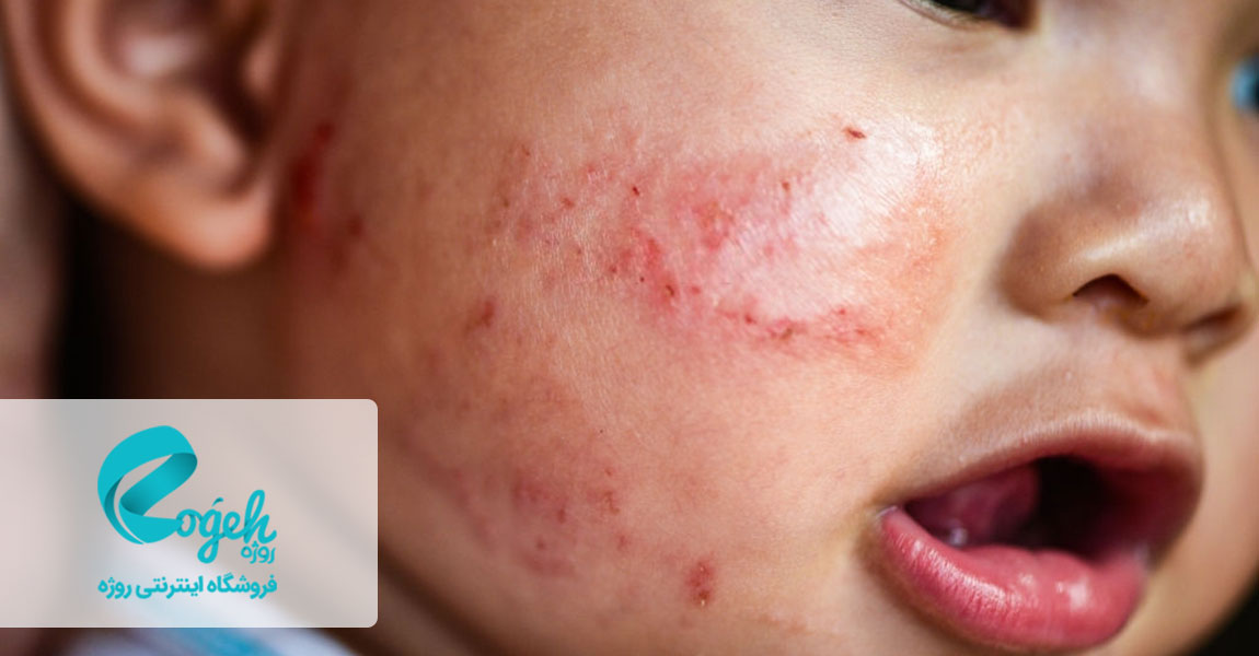 درمان اگزما