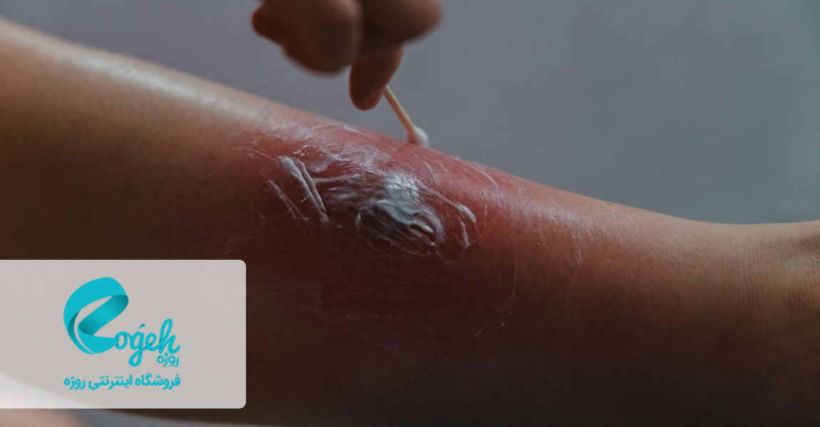 کرم‌های درمان اگزما