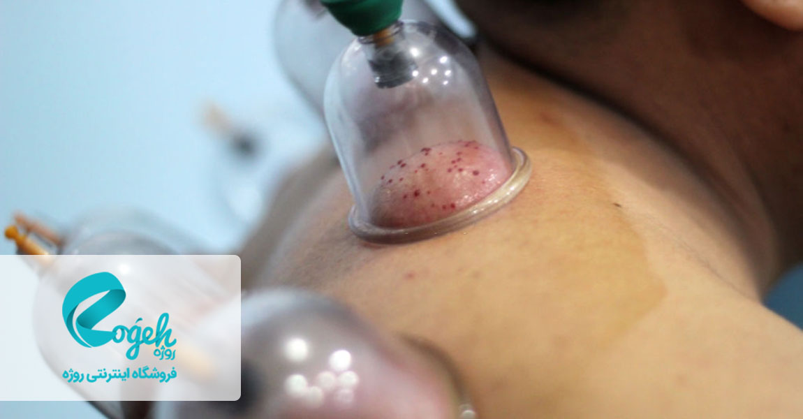 فواید حجامت