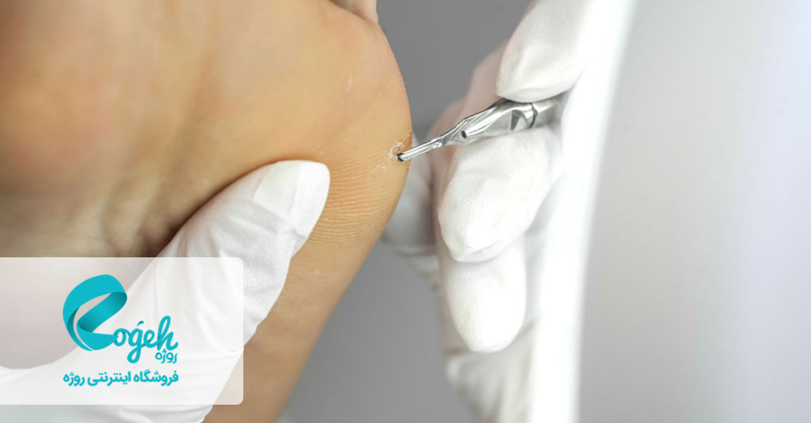 درمان پینه پا