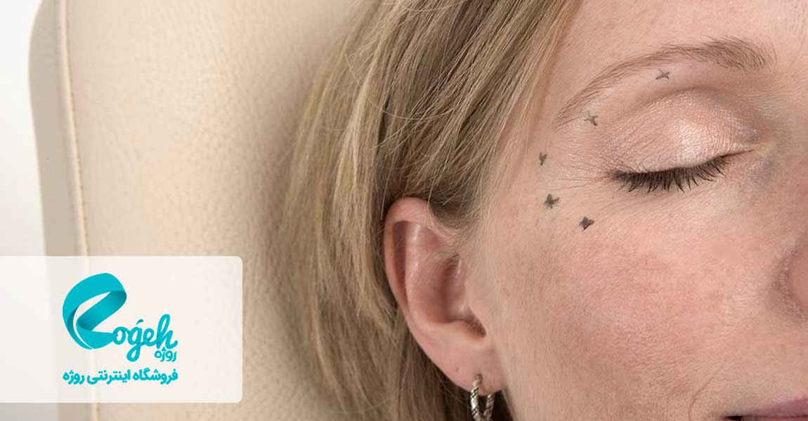 مزونیدلینگ دور چشم