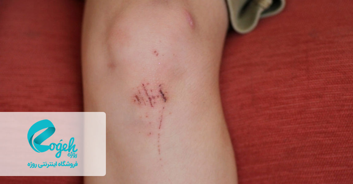 هیالورنیک اسید