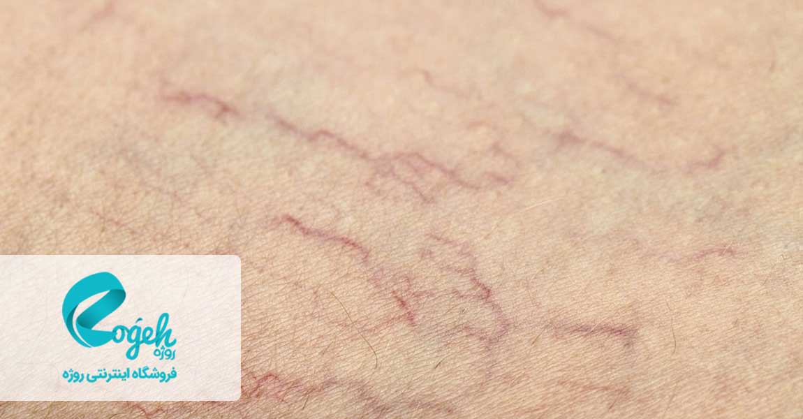 رگ های عنکبوتی