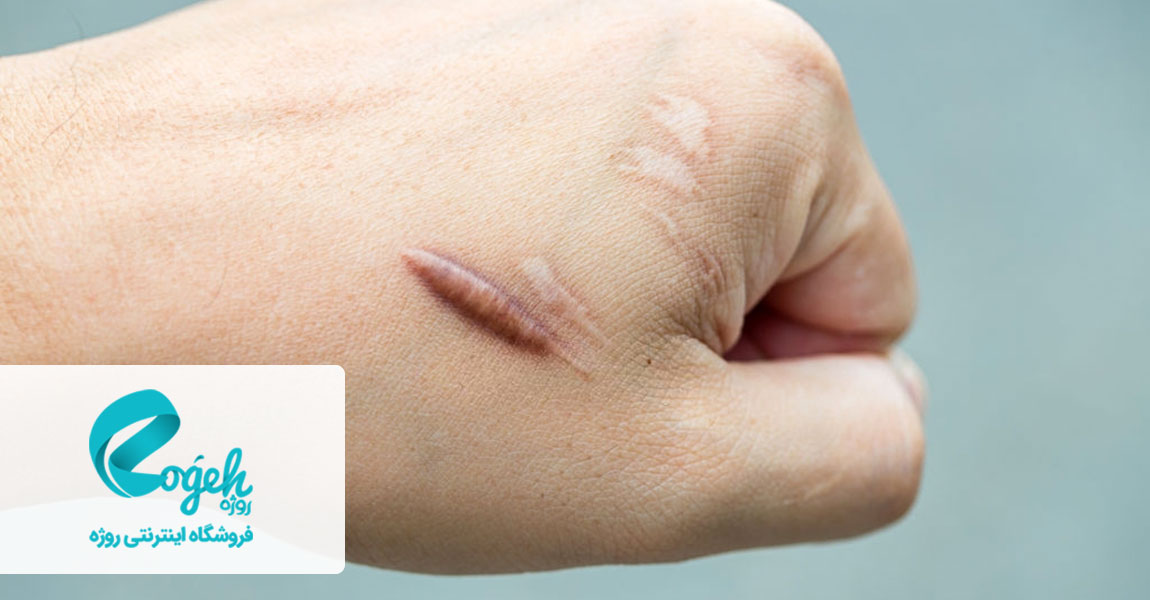 درمان گوشت اضافه