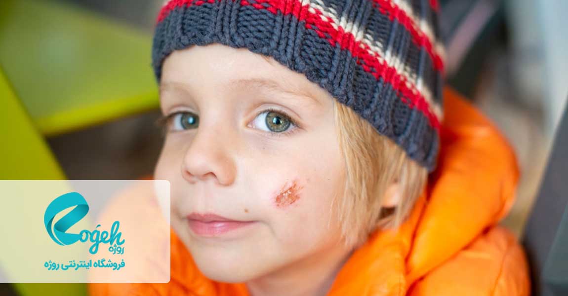 پیشگیری از کلوئید