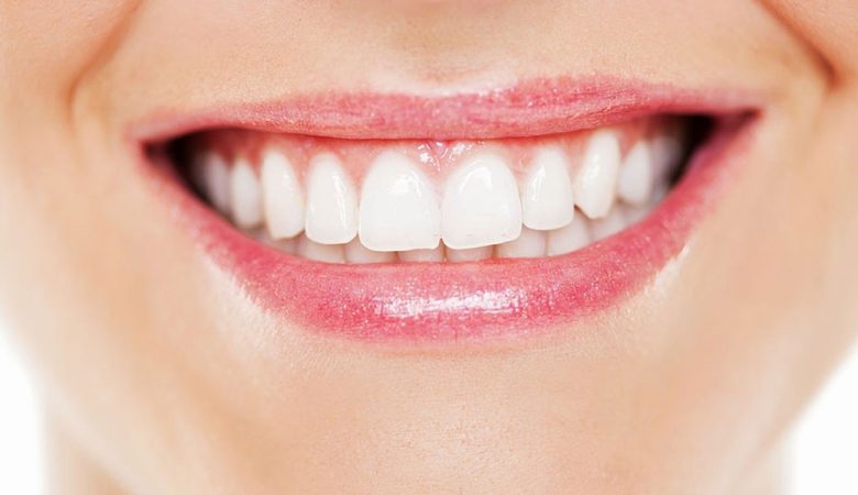 بلیچینگ دندان