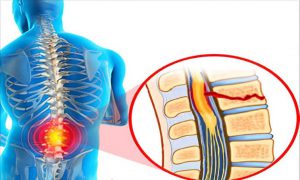 آسیب ‎های نخاعی
