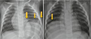 علائم بیماری دیفتری 