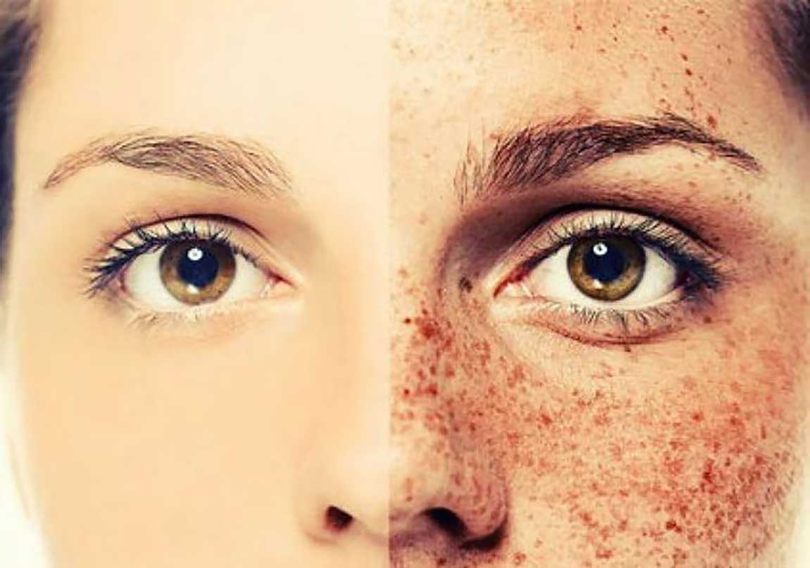 مشکل هیدروکینون