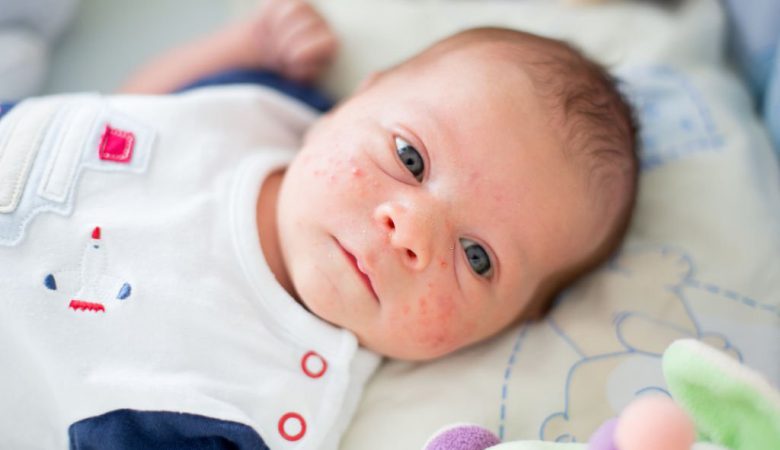 اگزمای کودکان