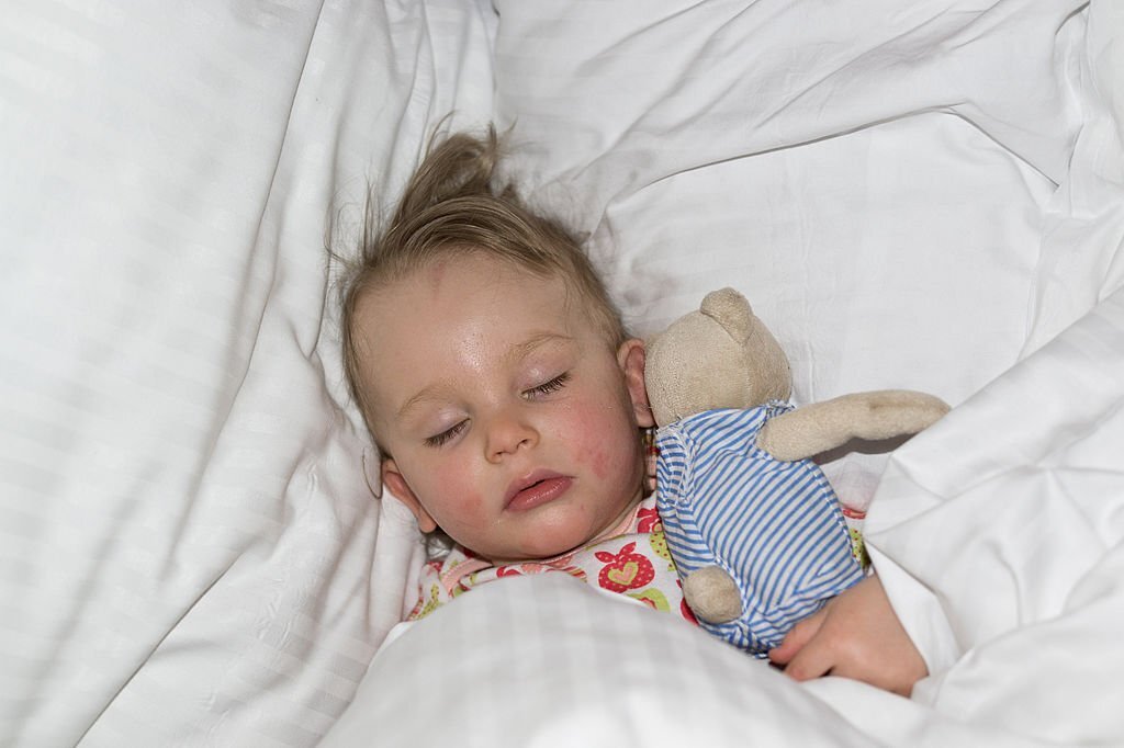 بیماری اگزما