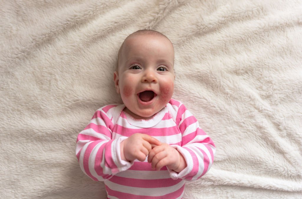 درمان اگزما