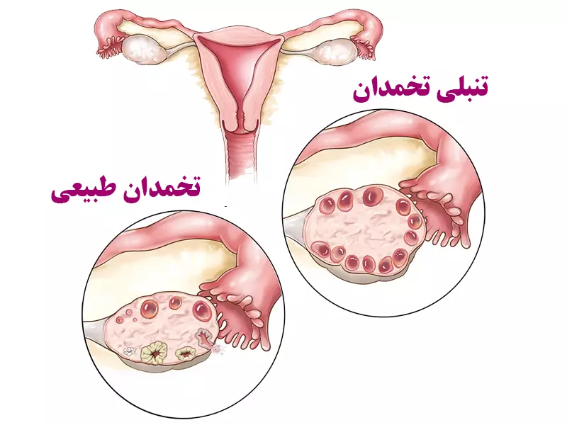اندازه تخمدان تنبل